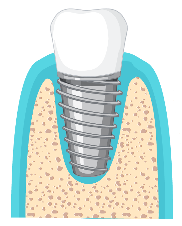 Zahn ohne Periimplantitis